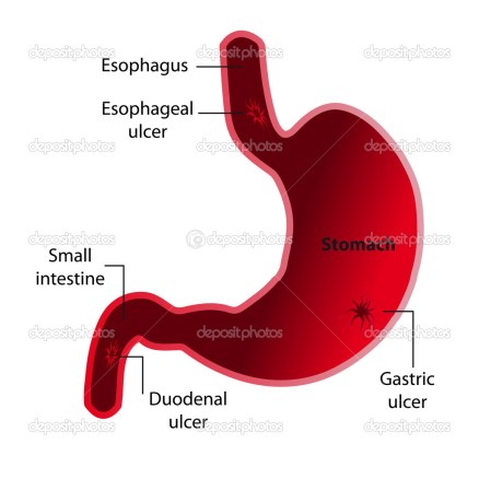 depositphotos_7163081-stock-illustration-gastric-ulcer.jpg